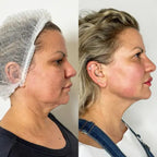 Harmonize Face™ - Máscara Modeladora Facial