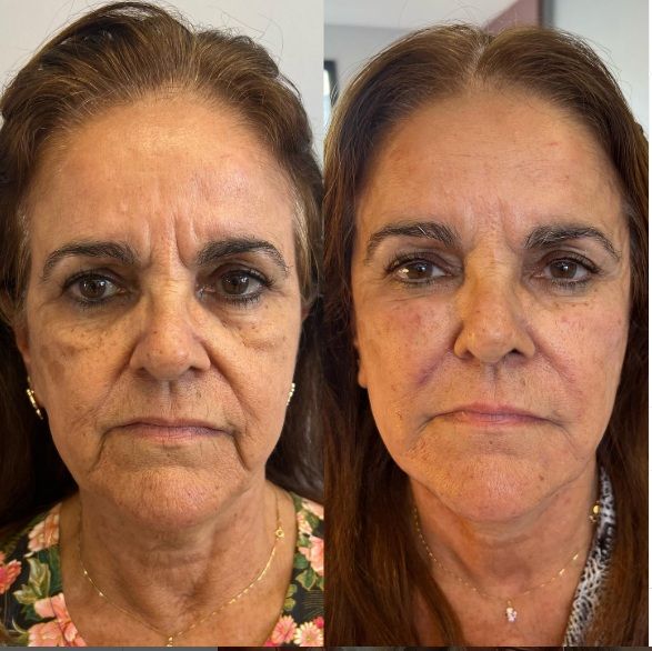 Massageador Facial de Gelo - GlowFrost