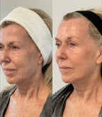 Harmonize Face™ - Máscara Modeladora Facial