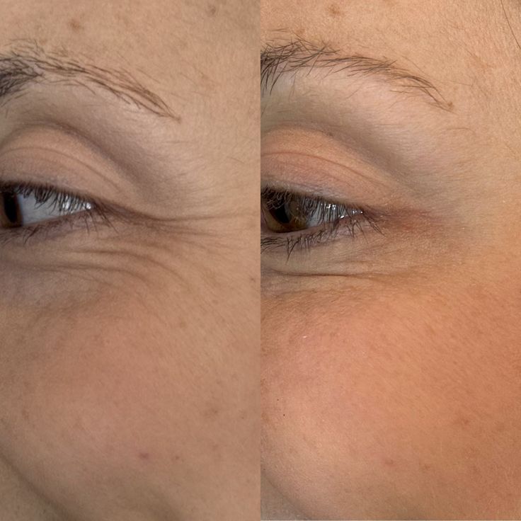 Derma Roller de Colágeno