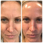 Massageador Facial com Fototerapia Anti-Rugas - DermaLift™