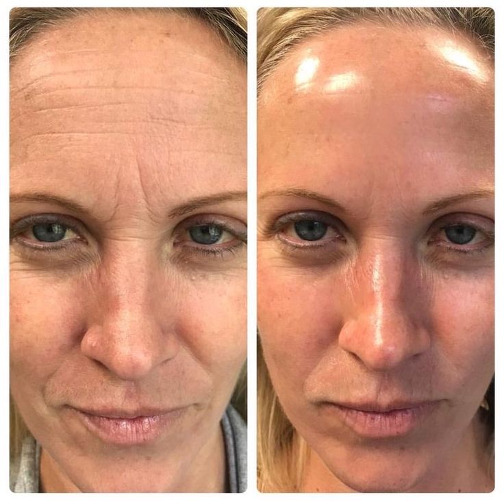 Massageador Facial com Fototerapia Anti-Rugas - DermaLift™