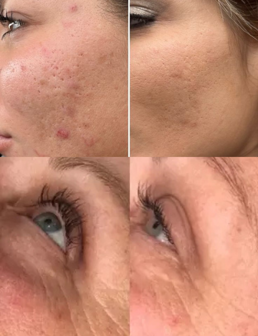 FaceLift™ Máscara de LED Terapia